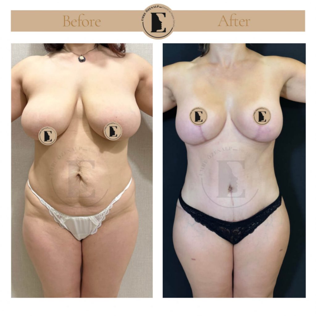 Borstverkleining voor en na resultaten in Turkije