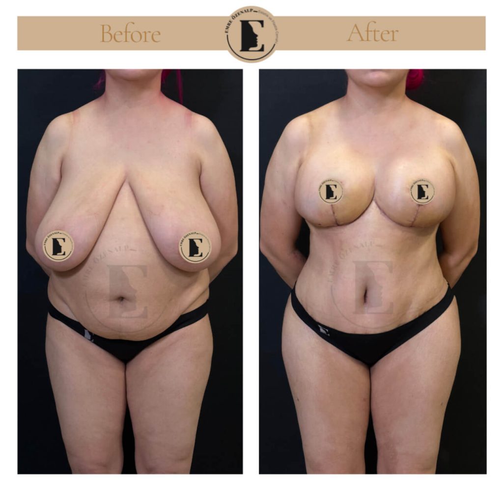 Borstverkleining voor en na resultaten in Turkije