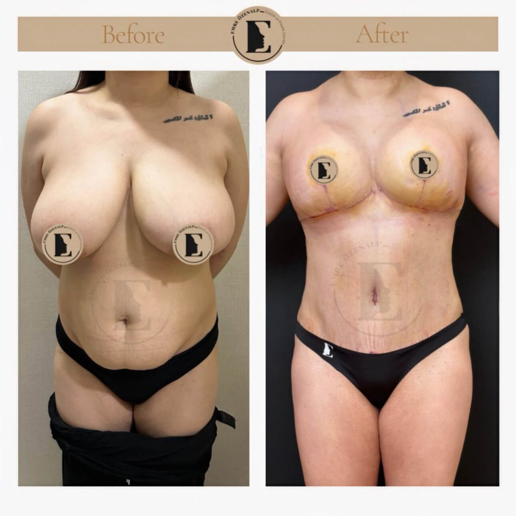 Borstverkleining voor en na resultaten in Turkije