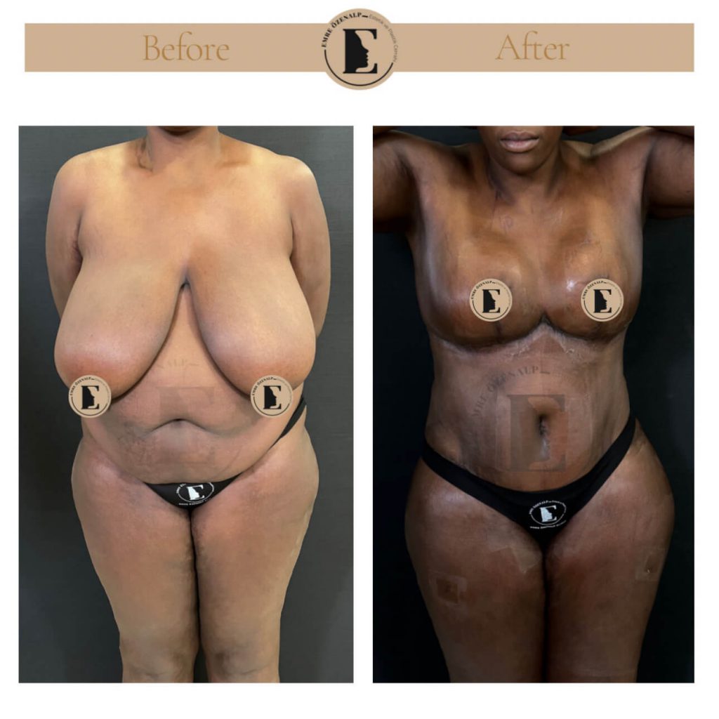 Borstverkleining voor en na resultaten in Turkije