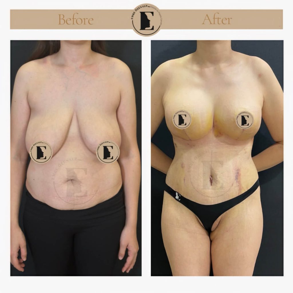 Borstverkleining voor en na resultaten in Turkije