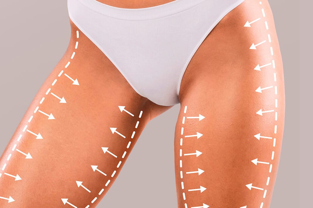 Dijbeenlift Turkije - Prijs, Voor en Na en Reviews