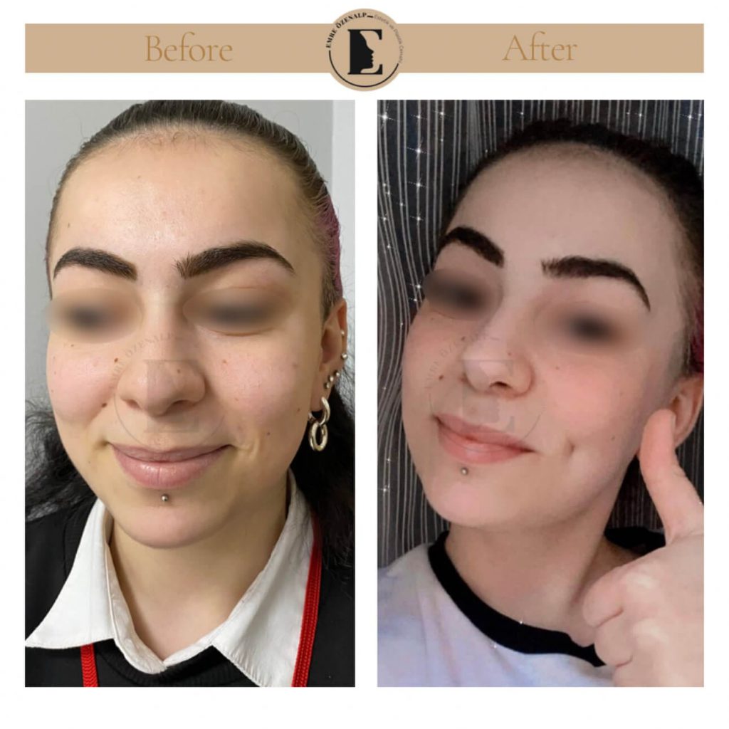 Kuiltjesoperatie voor en na in Turkije met resultaten door ervaren arts Emre Özenalp.