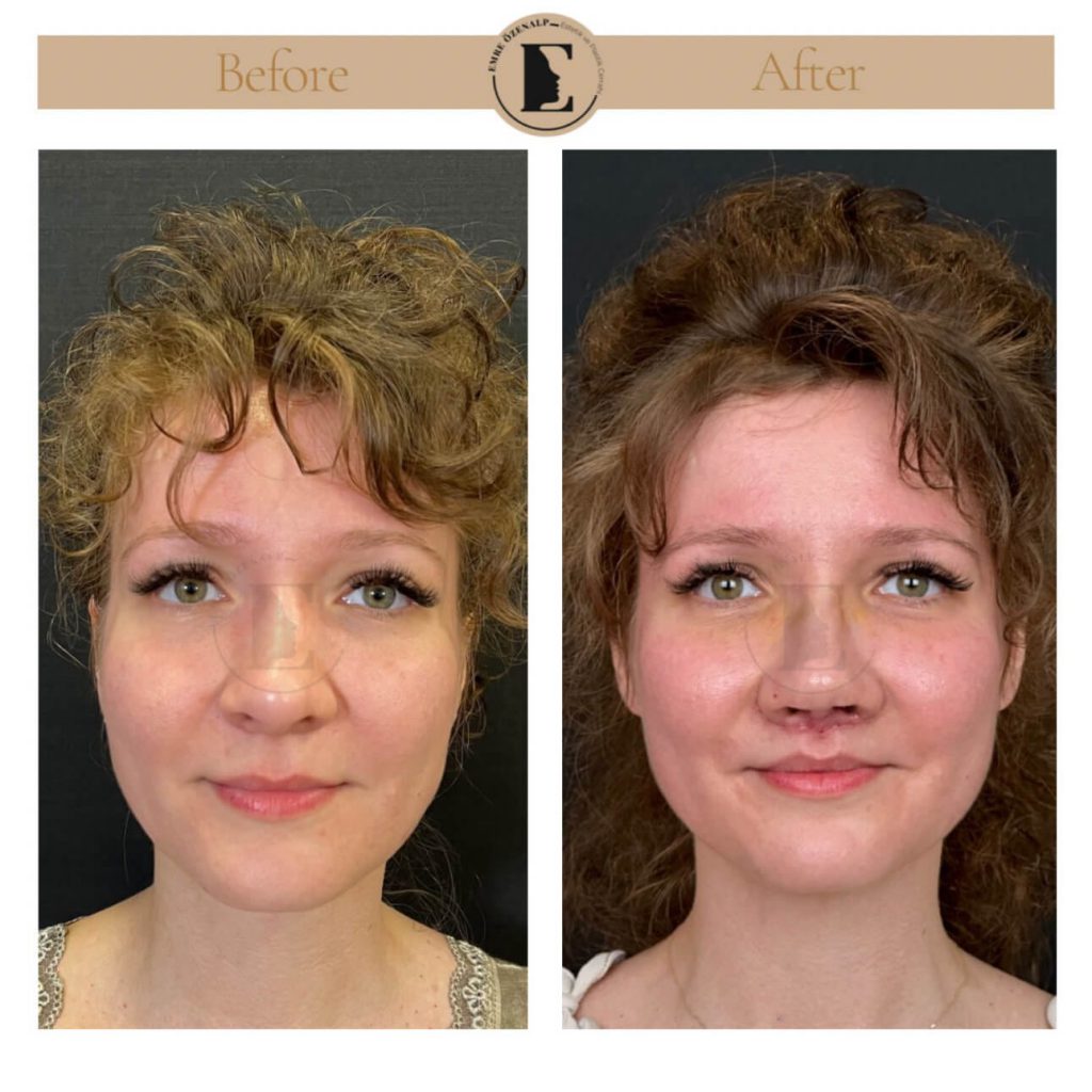 Liplift operatie voor na in Turkije resultaten met ervaren dokter Emre Özenalp. De patiënt heeft een bovenliplift operatie ondergaan