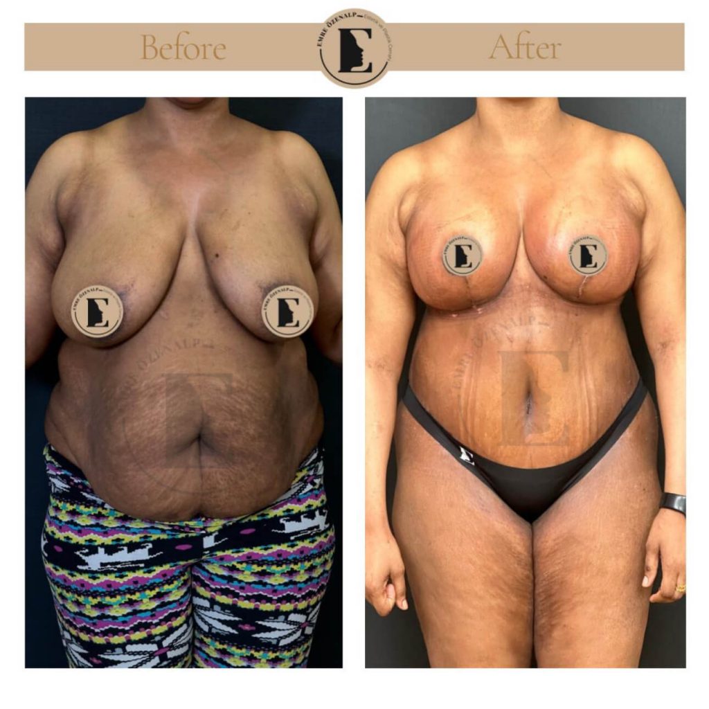 Mommy makeover voor na in Turkije resultaten met ervaren dokter Emre Özenalp. De patiënt heeft een borstlift met implantaat en een buikwandcorrectie met vaser liposuctie ondergaan.