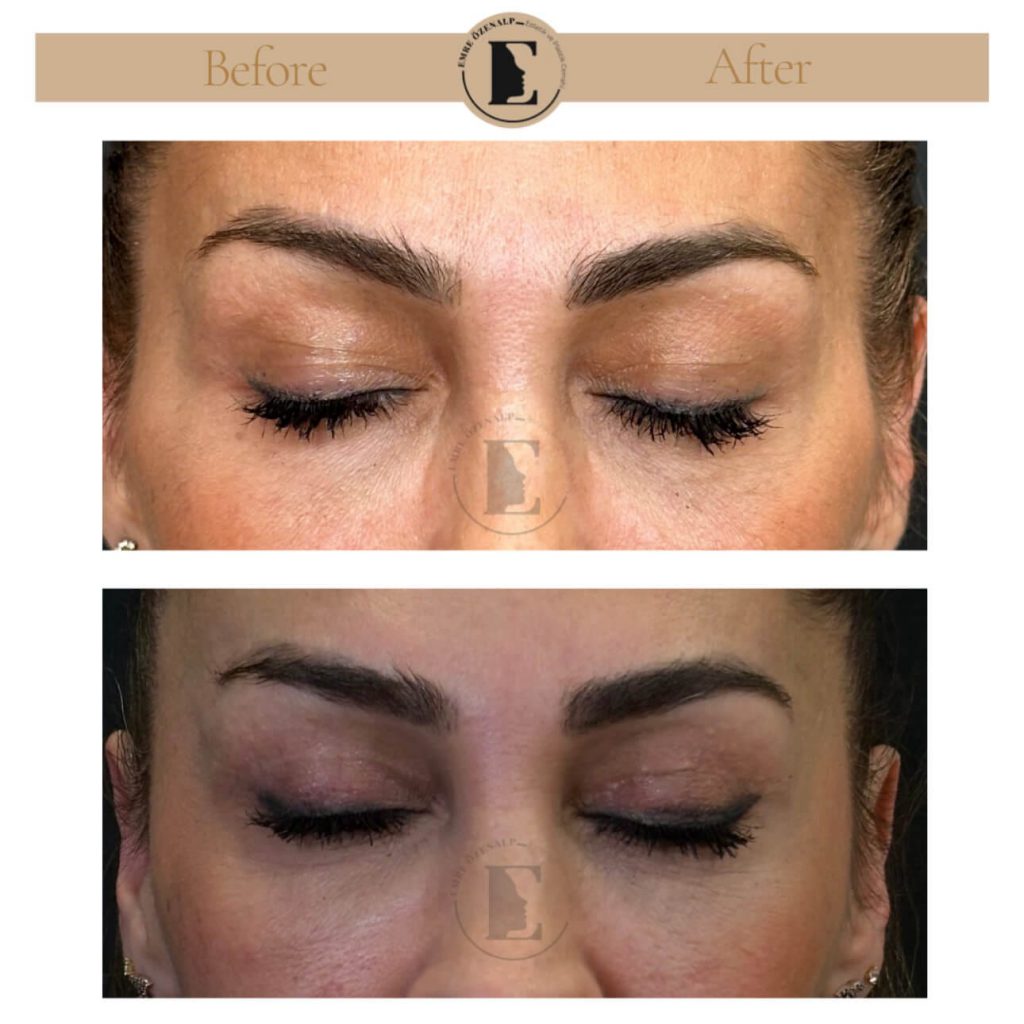 Ooglidcorrectie (blepharoplastiek) voor na in Turkije resultaten met ervaren arts Emre Özenalp. De patiënt heeft een ooglidcorrectie ondergaan.