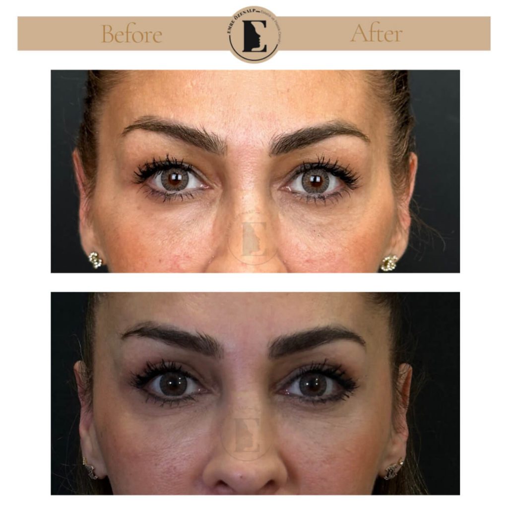 Ooglidcorrectie (blepharoplastiek) voor na in Turkije resultaten met ervaren arts Emre Özenalp. De patiënt heeft een ooglidcorrectie ondergaan.