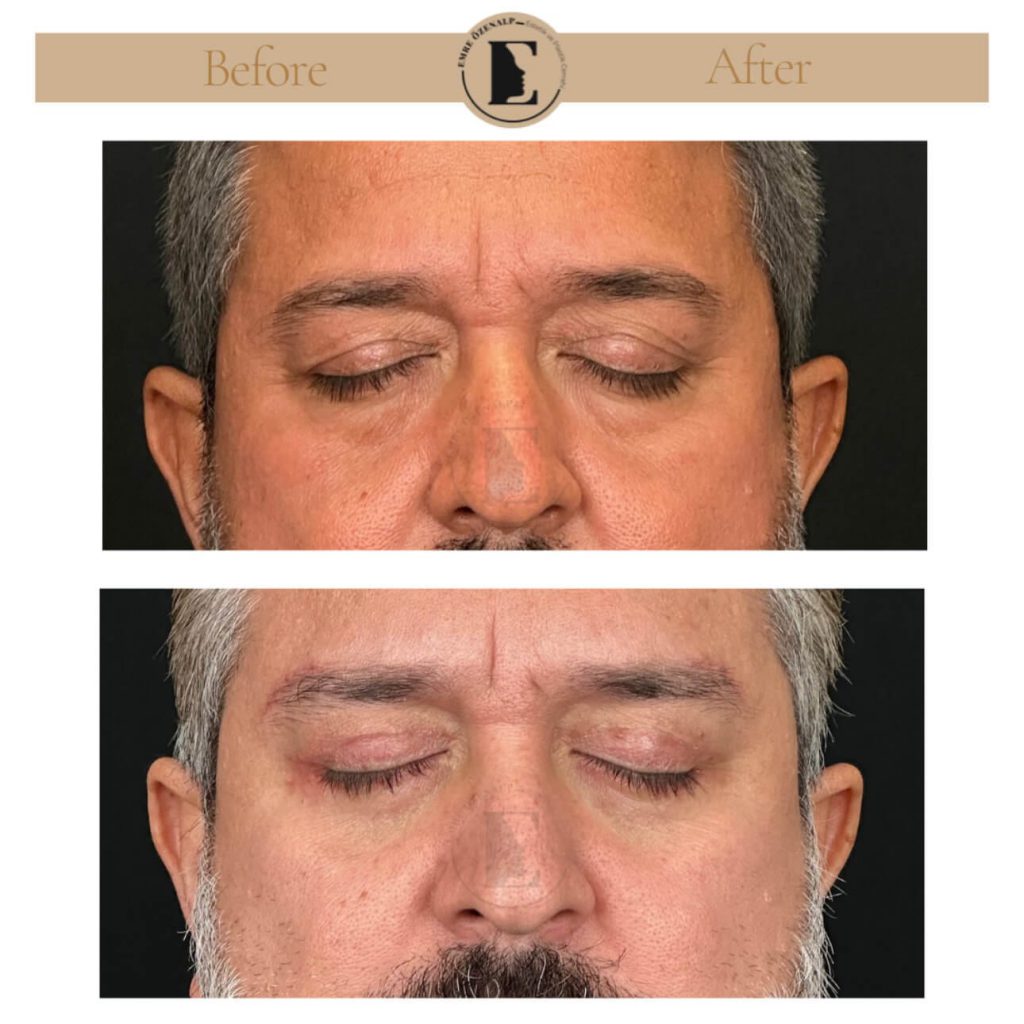 Ooglidcorrectie (blepharoplastiek) voor na in Turkije resultaten met ervaren arts Emre Özenalp. De patiënt heeft een ooglidcorrectie ondergaan.