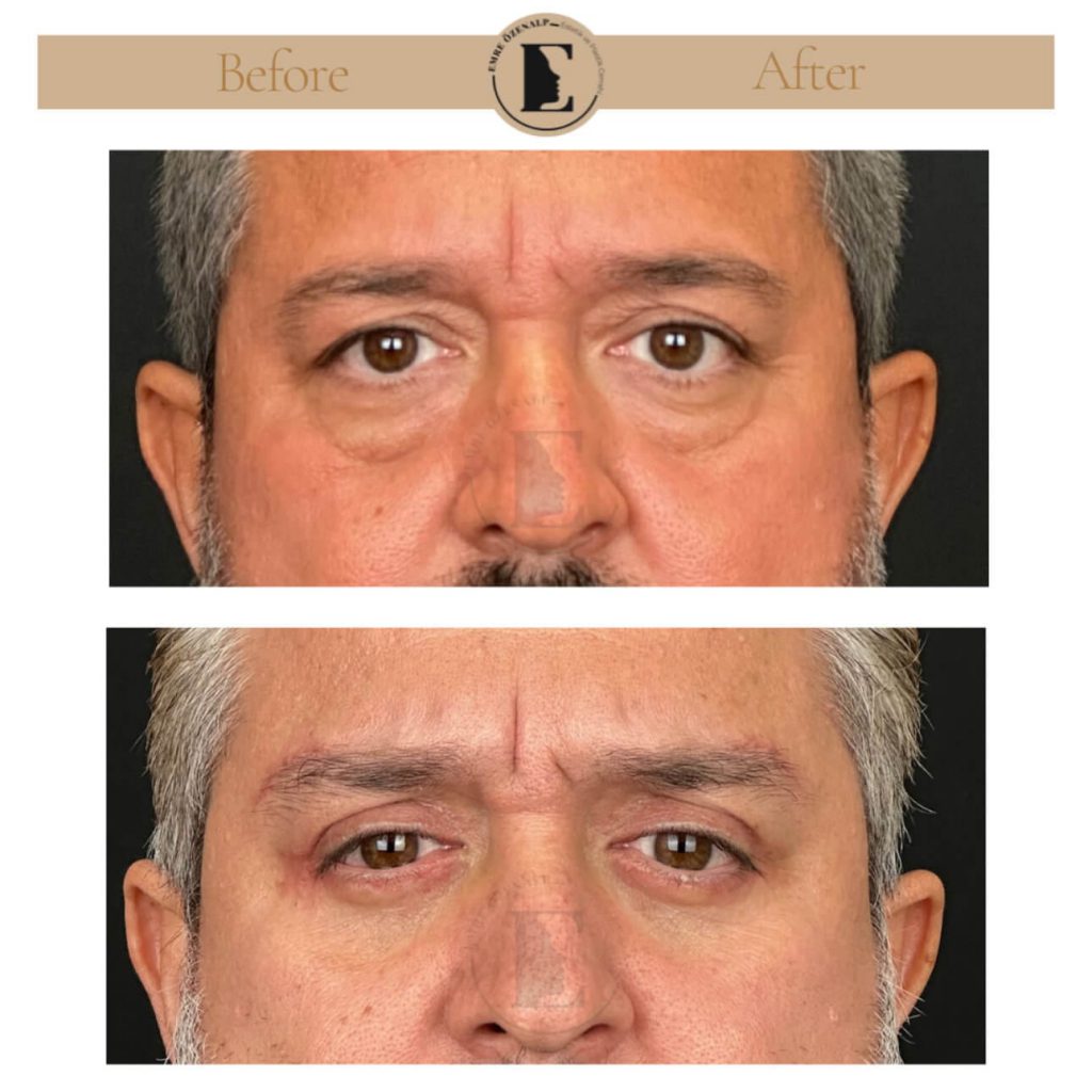 Ooglidcorrectie (blepharoplastiek) voor na in Turkije resultaten met ervaren arts Emre Özenalp. De patiënt heeft een ooglidcorrectie ondergaan.