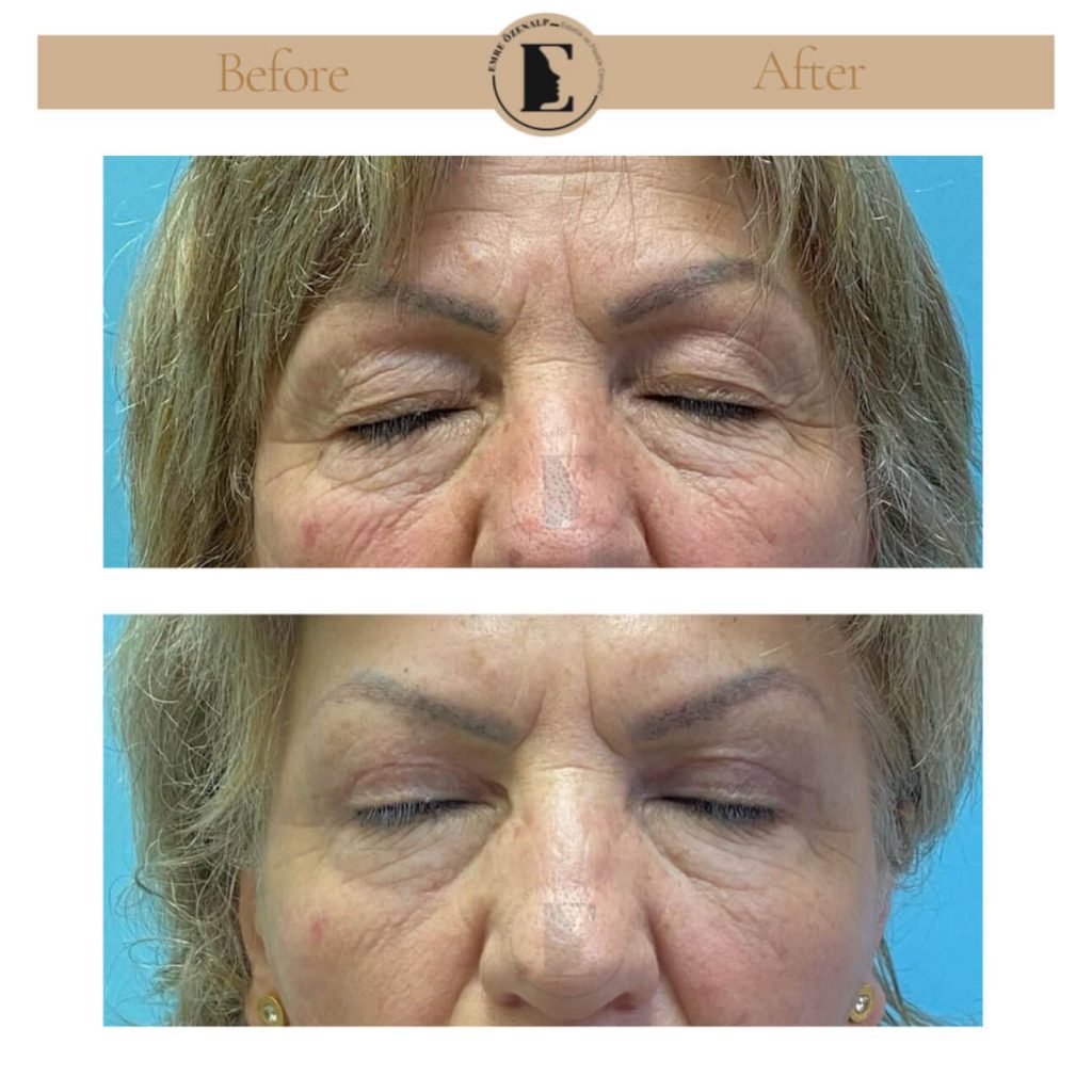 Ooglidcorrectie (blepharoplastiek) voor na in Turkije resultaten met ervaren arts Emre Özenalp. De patiënt heeft een ooglidcorrectie ondergaan.