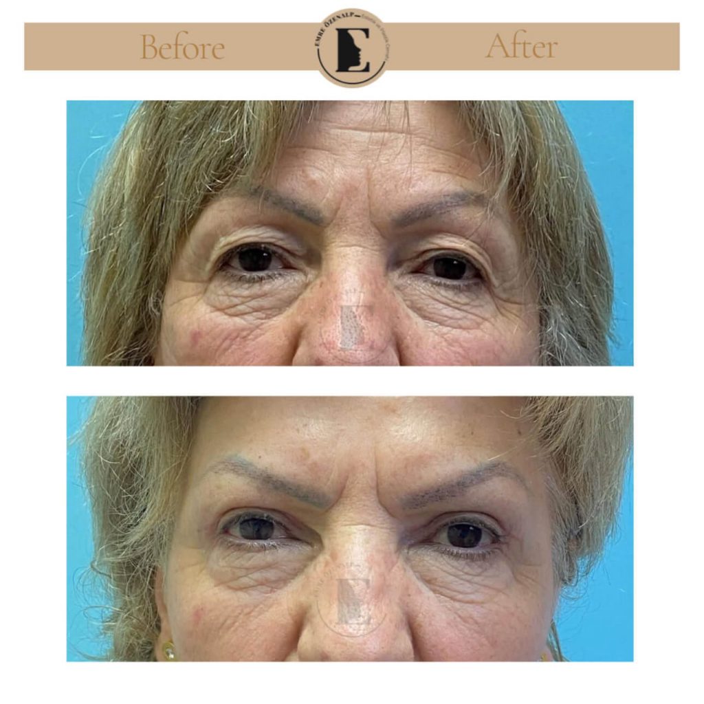 Ooglidcorrectie (blepharoplastiek) voor na in Turkije resultaten met ervaren arts Emre Özenalp. De patiënt heeft een ooglidcorrectie ondergaan.