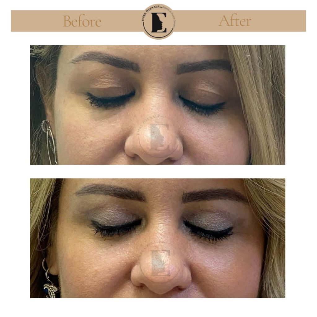 Ooglidcorrectie (blepharoplastiek) voor na in Turkije resultaten met ervaren arts Emre Özenalp. De patiënt heeft een ooglidcorrectie ondergaan.