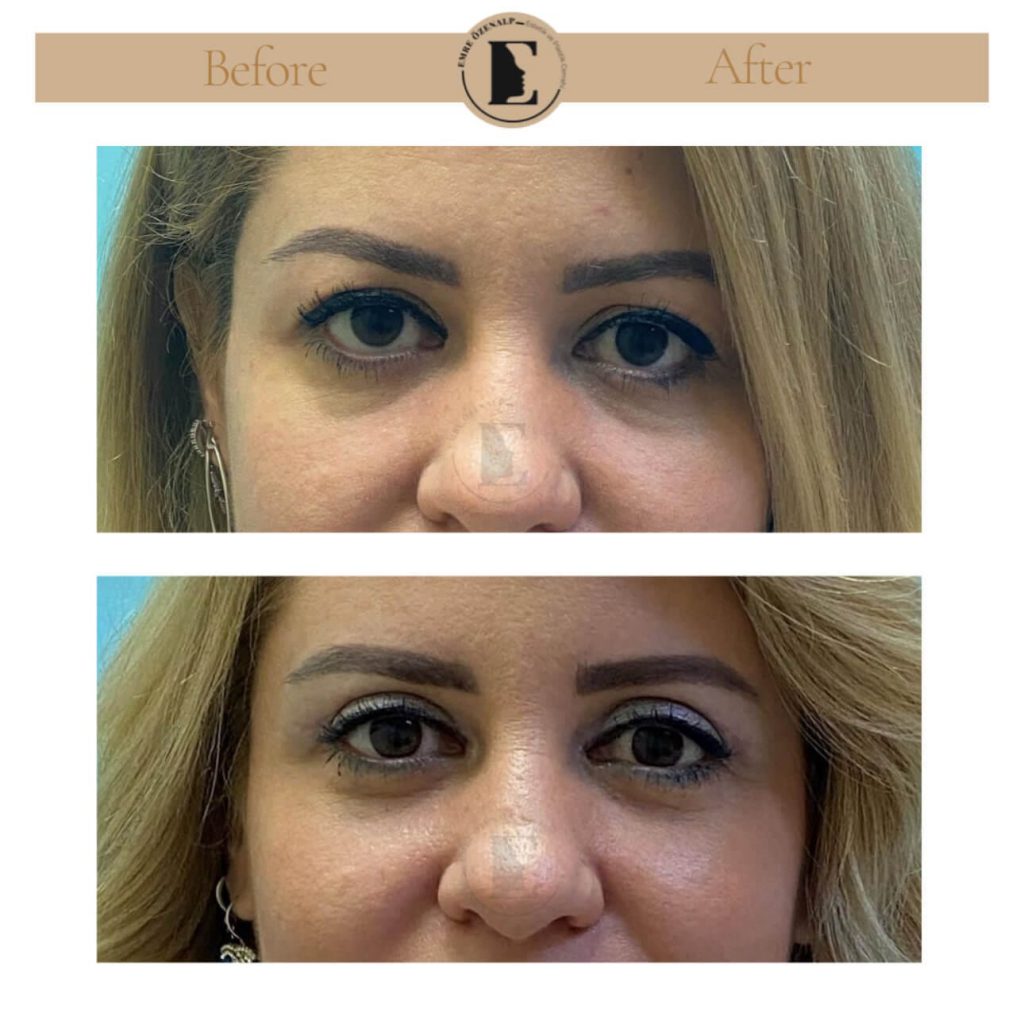 Ooglidcorrectie (blepharoplastiek) voor na in Turkije resultaten met ervaren arts Emre Özenalp. De patiënt heeft een ooglidcorrectie ondergaan.
