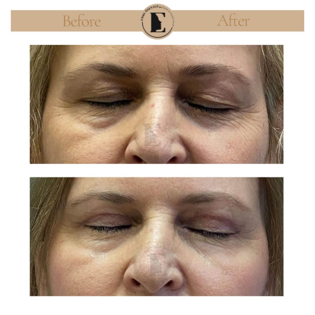 Ooglidcorrectie (blepharoplastiek) voor na in Turkije resultaten met ervaren arts Emre Özenalp. De patiënt heeft een ooglidcorrectie ondergaan.