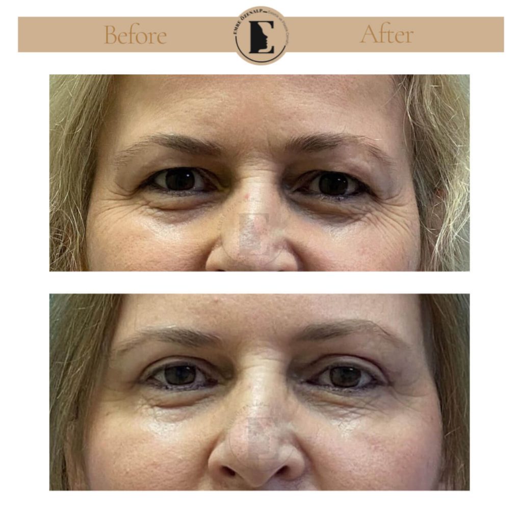 Ooglidcorrectie (blepharoplastiek) voor na in Turkije resultaten met ervaren arts Emre Özenalp. De patiënt heeft een ooglidcorrectie ondergaan.