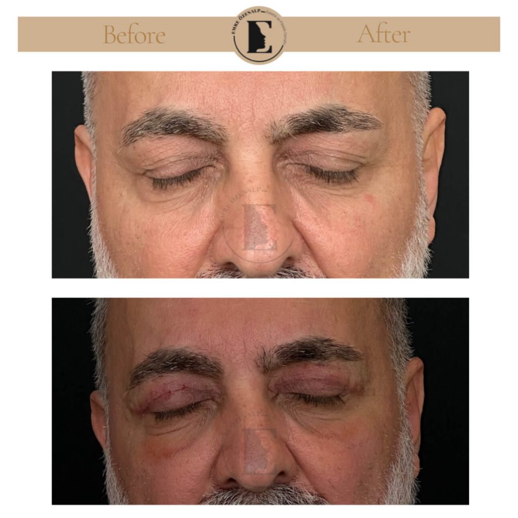 Ooglidcorrectie (blepharoplastiek) voor na in Turkije resultaten met ervaren arts Emre Özenalp. De patiënt heeft een ooglidcorrectie ondergaan.