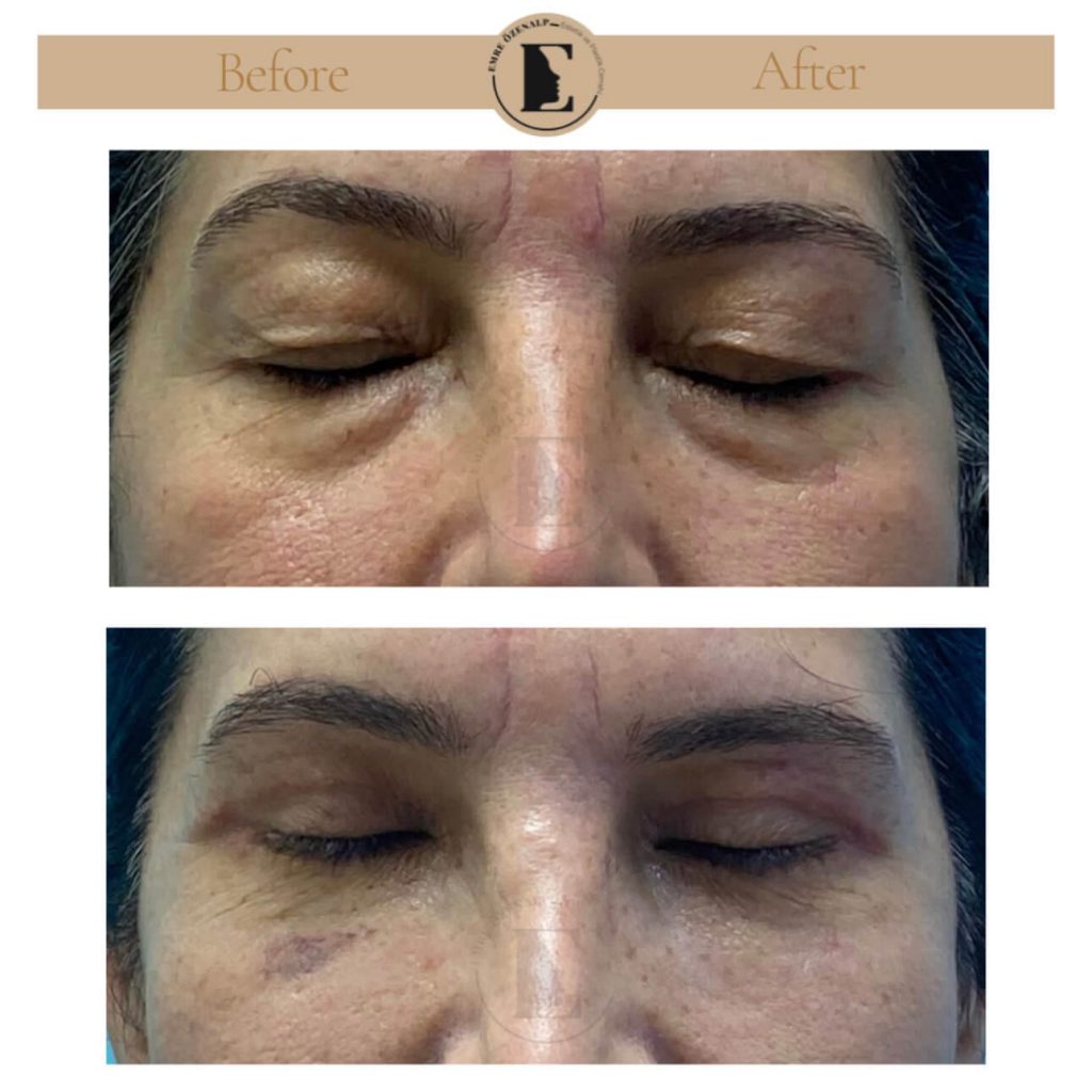 Ooglidcorrectie (blepharoplastiek) voor na in Turkije resultaten met ervaren arts Emre Özenalp. De patiënt heeft een ooglidcorrectie ondergaan.