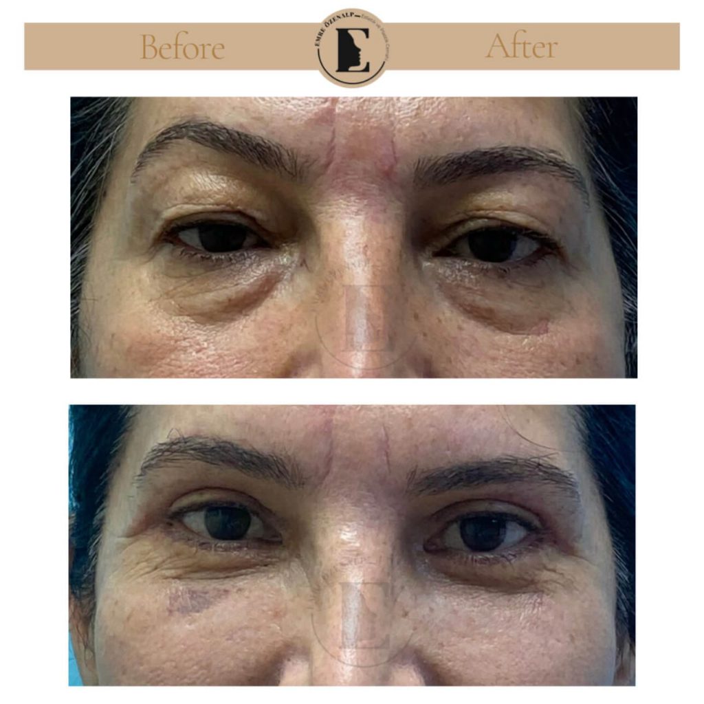 Ooglidcorrectie (blepharoplastiek) voor na in Turkije resultaten met ervaren arts Emre Özenalp. De patiënt heeft een ooglidcorrectie ondergaan.