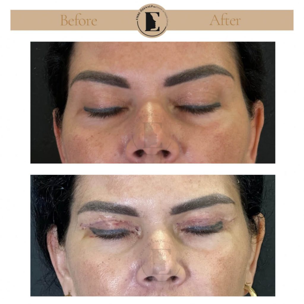 Ooglidcorrectie (blepharoplastiek) voor na in Turkije resultaten met ervaren arts Emre Özenalp. De patiënt heeft een ooglidcorrectie ondergaan.
