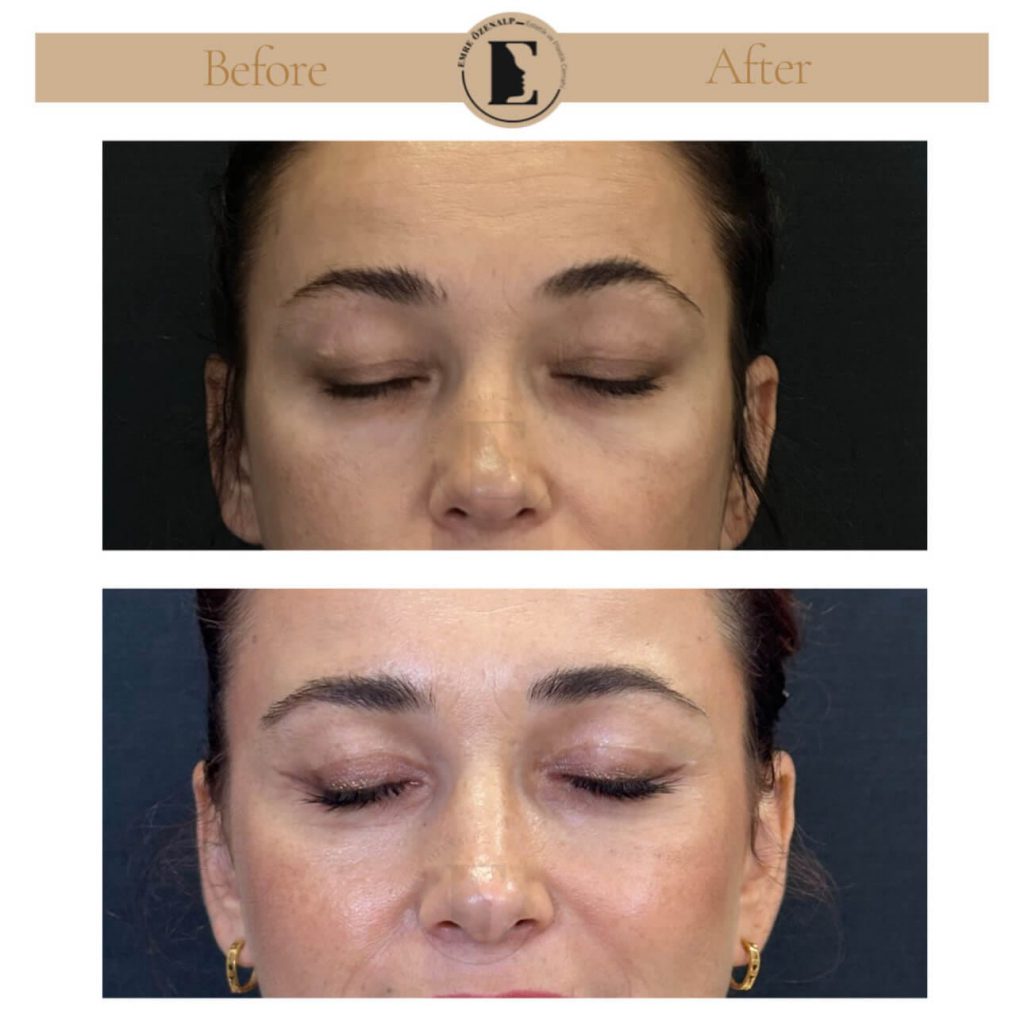 Ooglidcorrectie (blepharoplastiek) voor na in Turkije resultaten met ervaren arts Emre Özenalp. De patiënt heeft een ooglidcorrectie ondergaan.