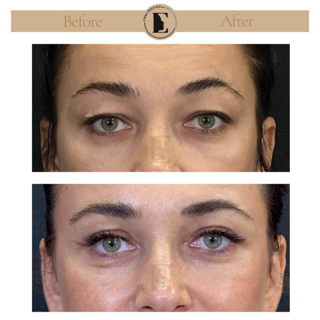 Ooglidcorrectie (blepharoplastiek) voor na in Turkije resultaten met ervaren arts Emre Özenalp. De patiënt heeft een ooglidcorrectie ondergaan.