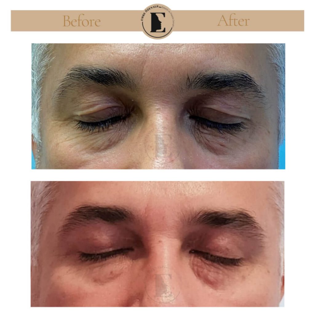 Ooglidcorrectie (blepharoplastiek) voor na in Turkije resultaten met ervaren arts Emre Özenalp. De patiënt heeft een ooglidcorrectie ondergaan.