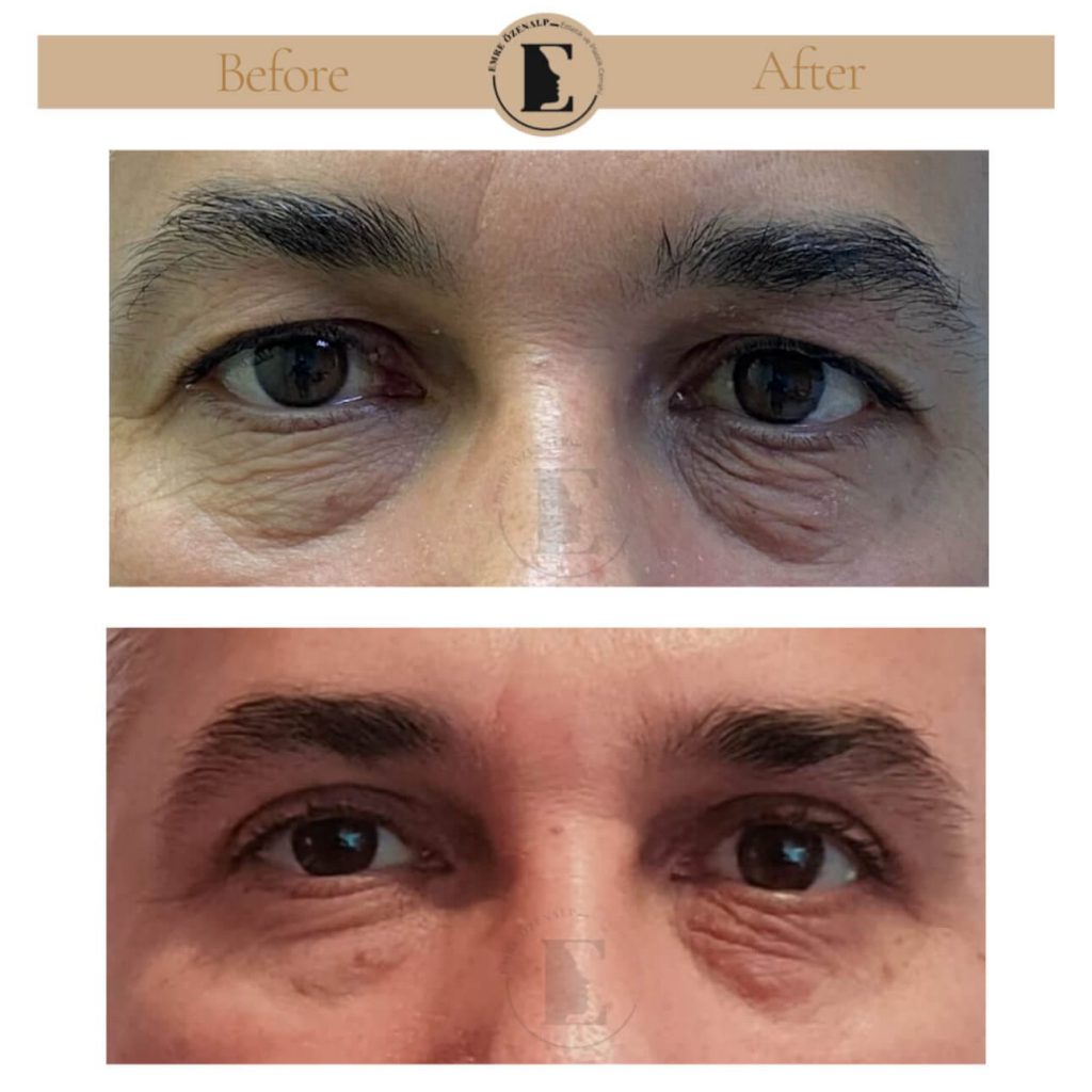 Ooglidcorrectie (blepharoplastiek) voor na in Turkije resultaten met ervaren arts Emre Özenalp. De patiënt heeft een ooglidcorrectie ondergaan.