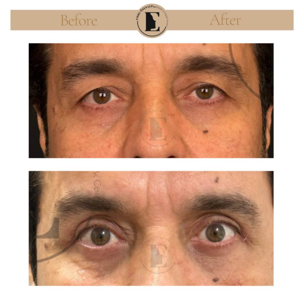 Ooglidcorrectie (blepharoplastiek) voor na in Turkije resultaten met ervaren arts Emre Özenalp. De patiënt heeft een ooglidcorrectie ondergaan.