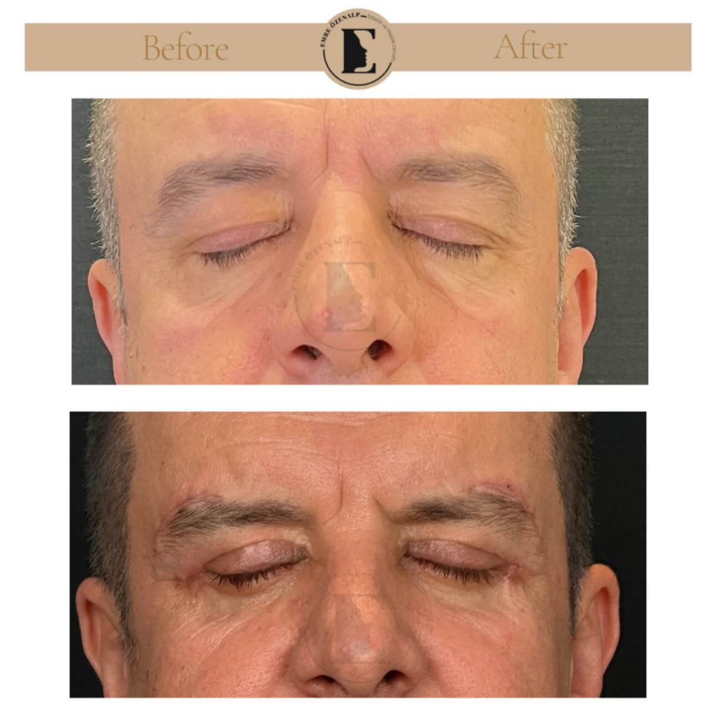 Ooglidcorrectie (blepharoplastiek) voor na in Turkije resultaten met ervaren arts Emre Özenalp. De patiënt heeft een ooglidcorrectie ondergaan.