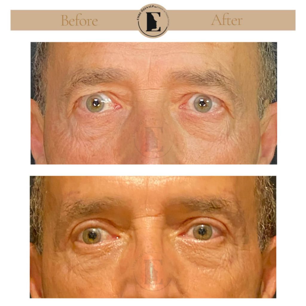 Ooglidcorrectie (blepharoplastiek) voor na in Turkije resultaten met ervaren arts Emre Özenalp. De patiënt heeft een ooglidcorrectie ondergaan.