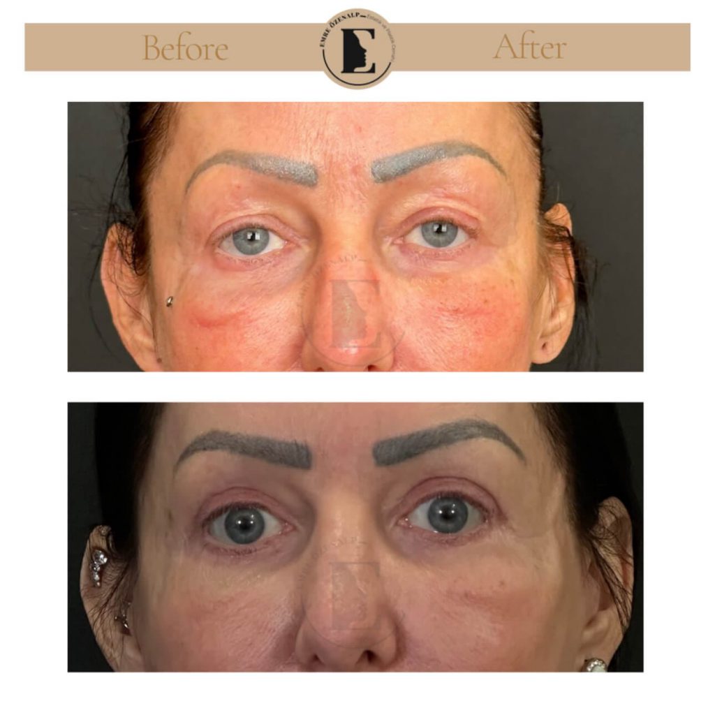 Ooglidcorrectie (blepharoplastiek) voor na in Turkije resultaten met ervaren arts Emre Özenalp. De patiënt heeft een ooglidcorrectie ondergaan.