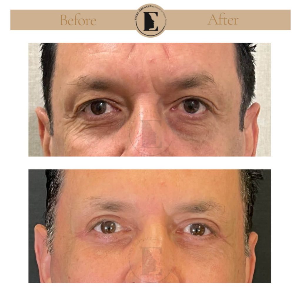 Ooglidcorrectie (blepharoplastiek) voor na in Turkije resultaten met ervaren arts Emre Özenalp. De patiënt heeft een ooglidcorrectie ondergaan.
