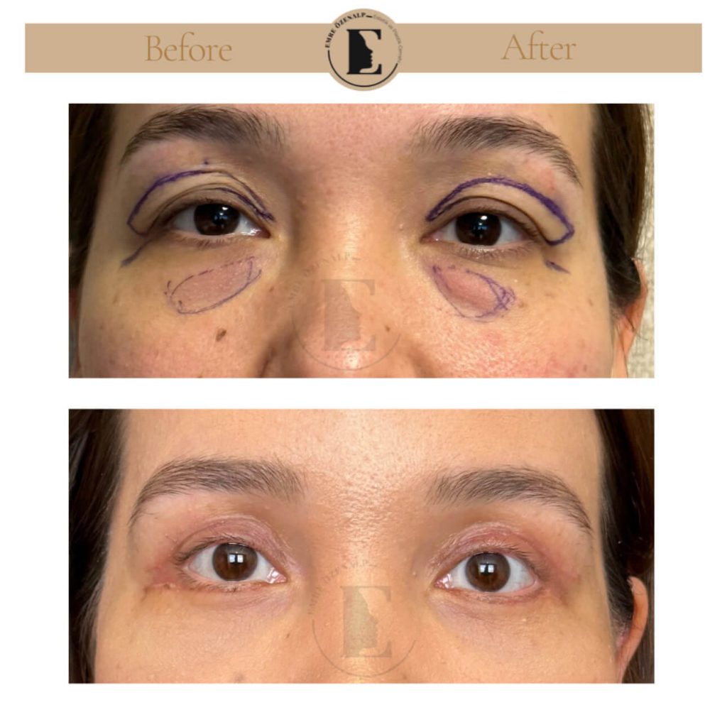 Ooglidcorrectie (blepharoplastiek) voor na in Turkije resultaten met ervaren arts Emre Özenalp. De patiënt heeft een ooglidcorrectie ondergaan.