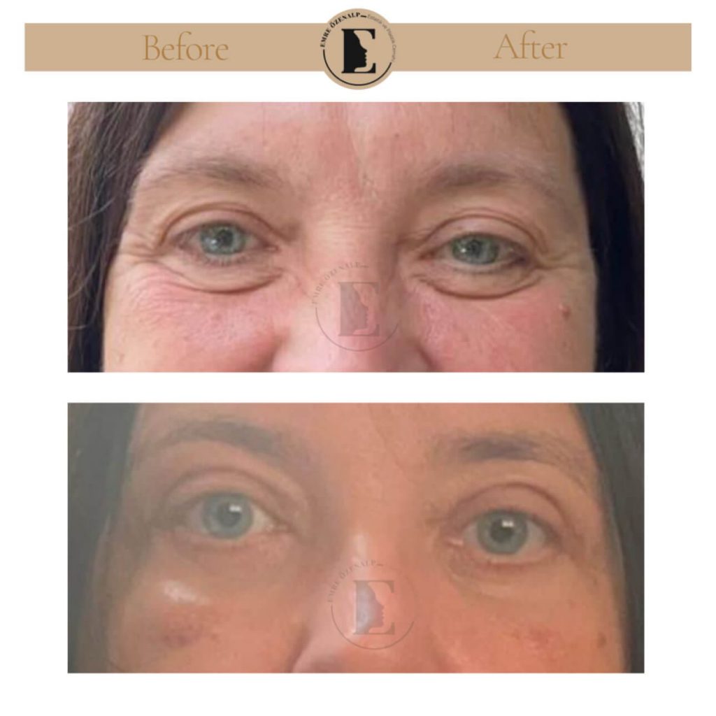Ooglidcorrectie (blepharoplastiek) voor na in Turkije resultaten met ervaren arts Emre Özenalp. De patiënt heeft een ooglidcorrectie ondergaan.