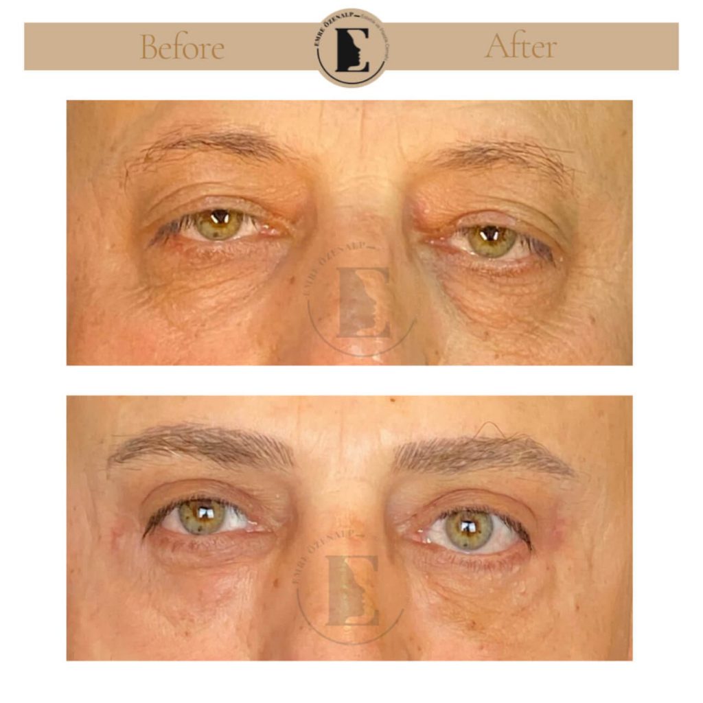 Ooglidcorrectie (blepharoplastiek) voor na in Turkije resultaten met ervaren arts Emre Özenalp. De patiënt heeft een ooglidcorrectie ondergaan.
