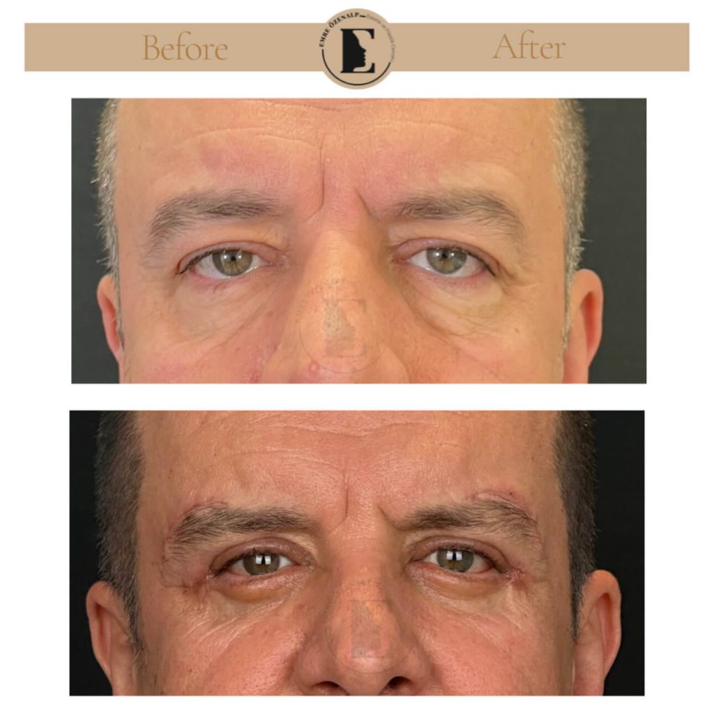 Ooglidcorrectie (blepharoplastiek) voor na in Turkije resultaten met ervaren arts Emre Özenalp. De patiënt heeft een ooglidcorrectie ondergaan.