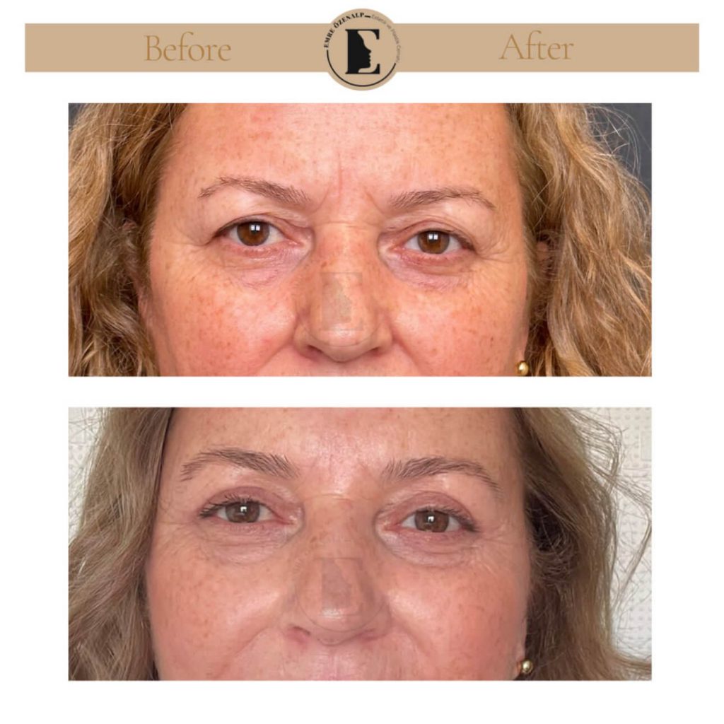 Ooglidcorrectie (blepharoplastiek) voor na in Turkije resultaten met ervaren arts Emre Özenalp. De patiënt heeft een ooglidcorrectie ondergaan.