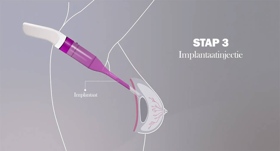 Mia Femtech implantaatinjectie stap