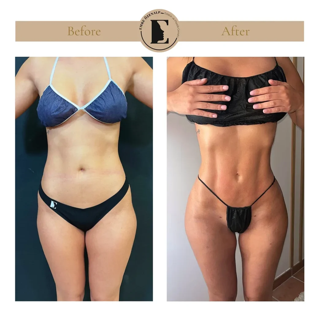 Skinny BBL resultaat Turkije – achteraanzicht met natuurlijke, vrouwelijke contour