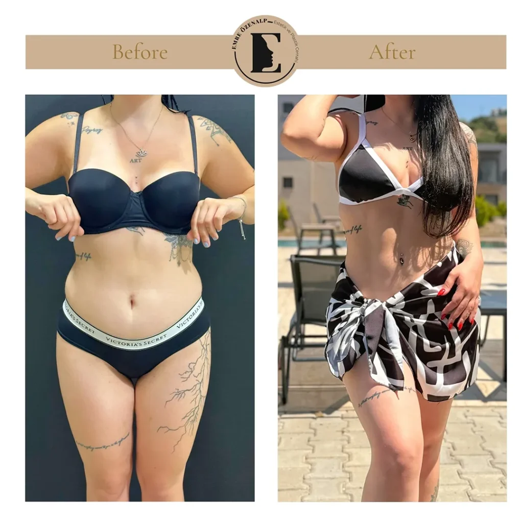 Skinny BBL resultaat Turkije – natuurlijk figuur in een korte rok na de ingreep