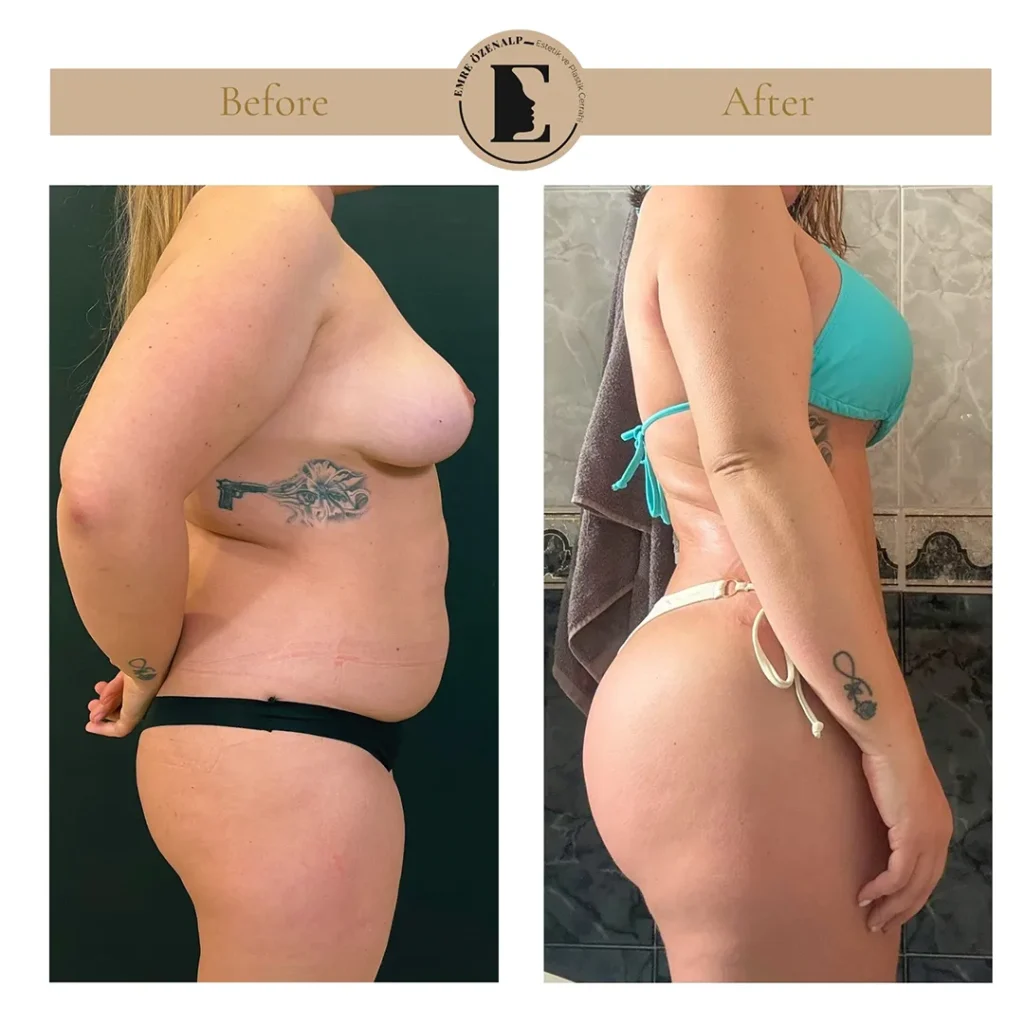 Skinny BBL resultaat Turkije – zijaanzicht met natuurlijke projectie en vloeiende contour