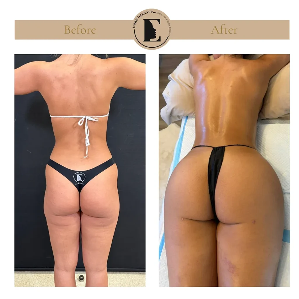 Skinny BBL resultaat Turkije – achteraanzicht met natuurlijke, vrouwelijke contour
