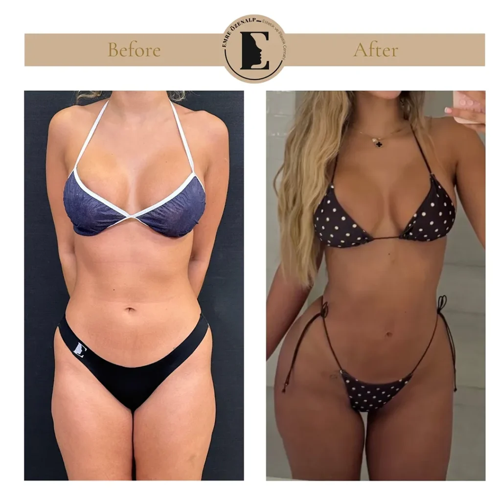 Skinny BBL resultaat Turkije – vooraanzicht in bikini bij een slanke patiënte