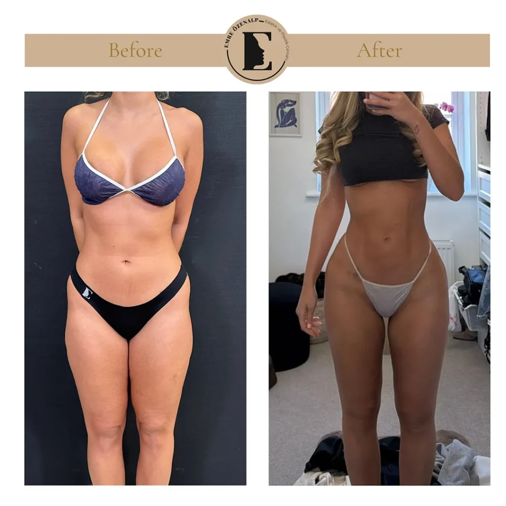 Skinny BBL voor en na Turkije – vooraanzicht in bikini met natuurlijk silhouet