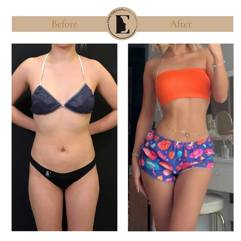 Skinny BBL resultaat Turkije – achteraanzicht met natuurlijke ronding bij slank figuur