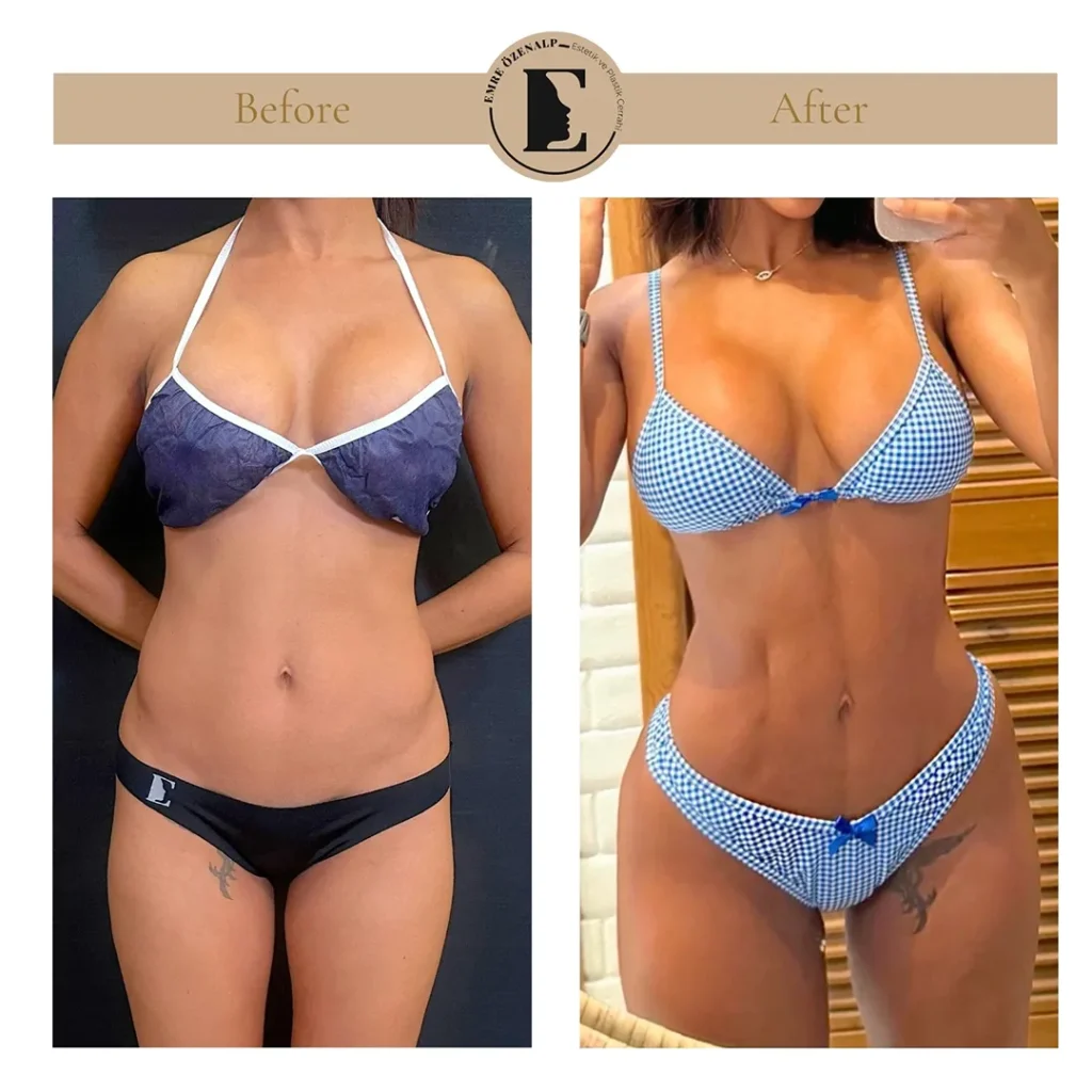 Skinny BBL resultaat Turkije – vooraanzicht in bikini, close-up