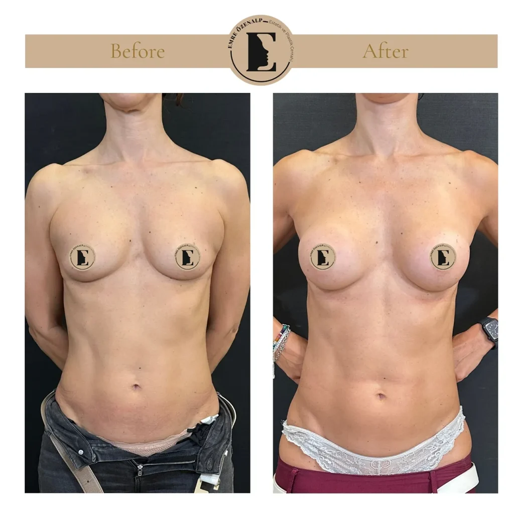 MIA Femtech borstvergroting voor en na resultaat 1 cup groter